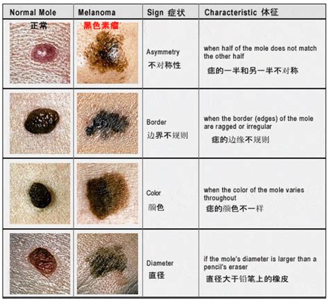 胸部長黑痣|身上三部位長「黑痣」竟是潛在「黑色素癌」？兩種黑痣外觀最危險